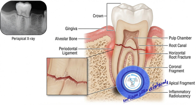 شکستگی ریشه دندان چیست؟ تشخیص با رادیوگرافی و CBCT