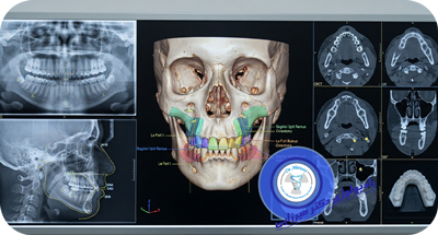 رادیولوژی قبل از جراحی فک چیست؟ بررسی CBCT و اطلاعات آن